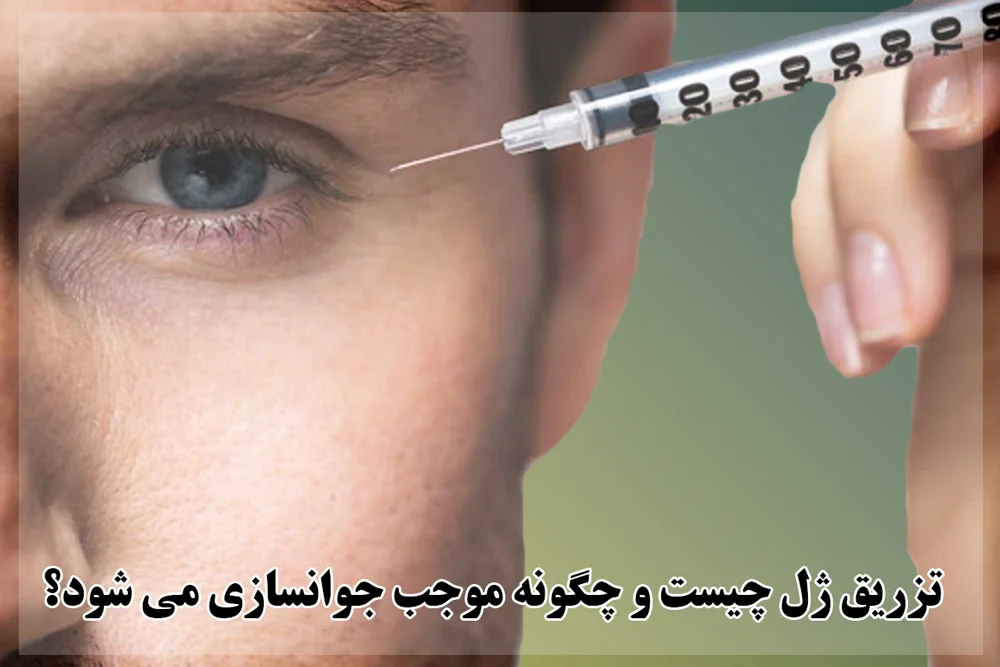 تزریق ژل دور چشم