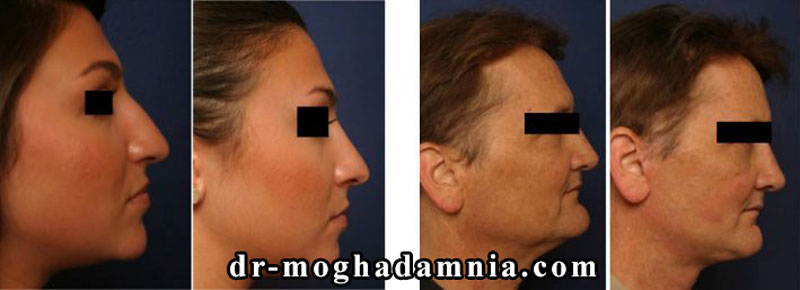 جراحی زیبایی چانه