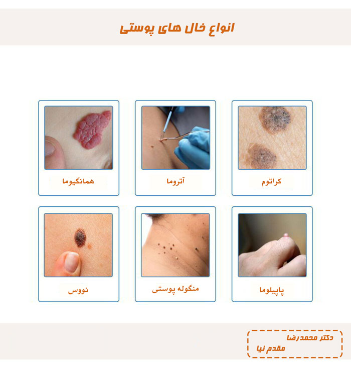 از کجا بفهمیم خال سرطانی است؟