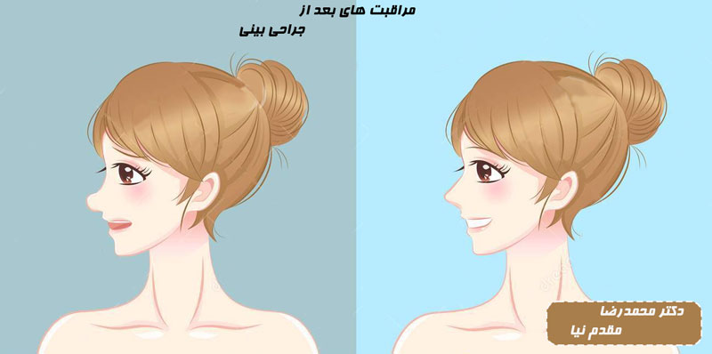 مراقبت های بعد از جراحی بینی