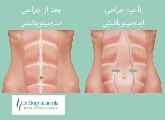 قبل و بعد ابدومینوپلاستی